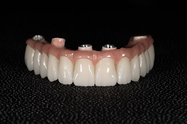 All On   Dental Implants: A Permanent Fix For Missing Teeth