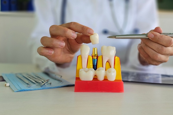 Dental Crown Vs Filling: Which Is The Better Option?