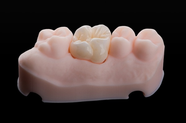 Maintenance Tips To Help Dental Crowns Last
