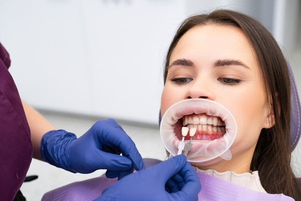 Questions To Ask Before Getting Dental Veneers