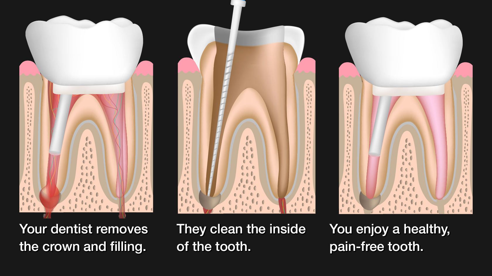 Root Canals - La Verne Dental & Implant