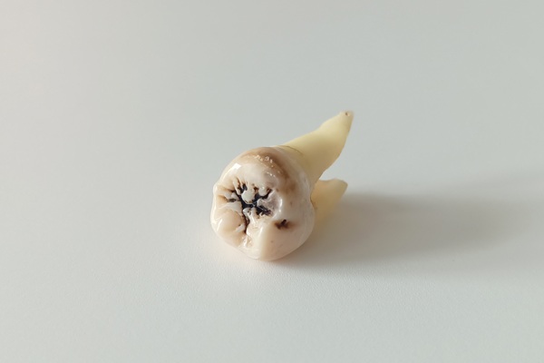 Tooth Extractions Demystified: When, Why &#   ; What To Expect